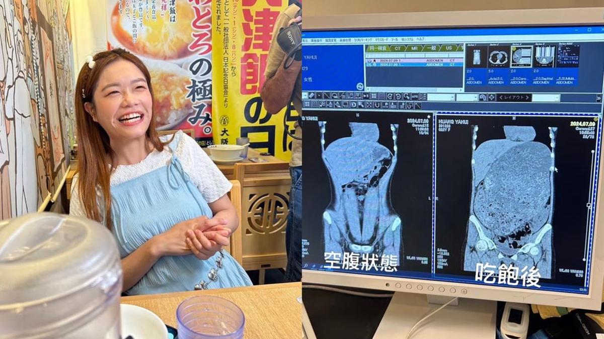 Mengerikan, Perut Bintang Mukbang Taiwan Mengalami Pembengkakan Drastis