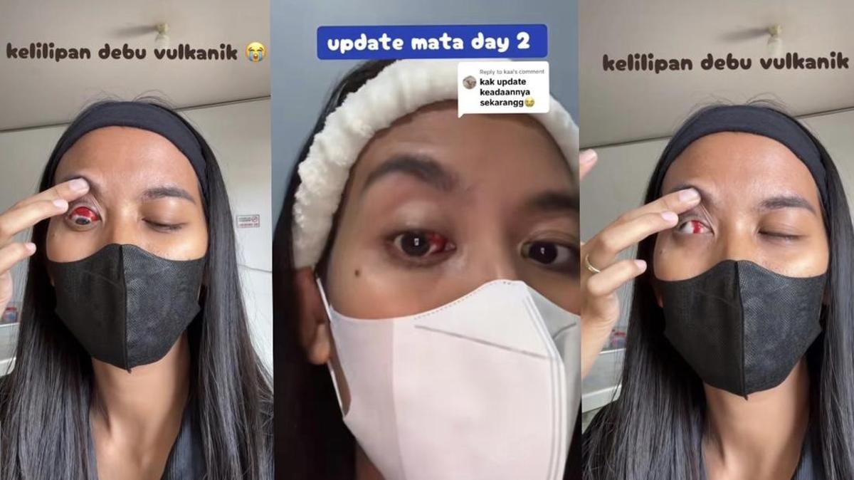 Kisah Warga Tanggamus Alami Pecah Pembuluh Darah di Mata Akibat Abu Vulkanik