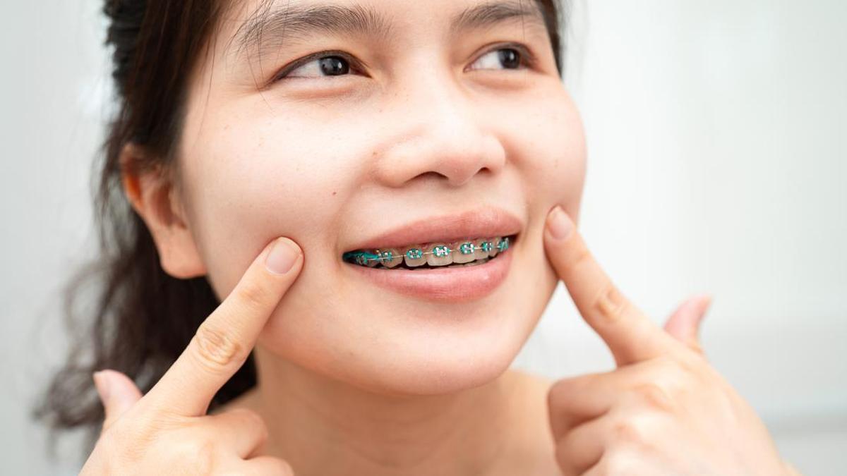 Fenomena "Iyup Moment" pada Pengguna Behel