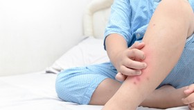 Ketahui Gejalanya, Ini Beda Gatal Campak dan Cacar Air