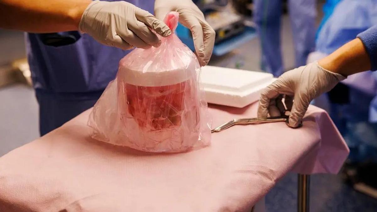 Pria di AS Bertahan 271 Hari dengan Ginjal Babi Sebelum Mendapat Donor Manusia