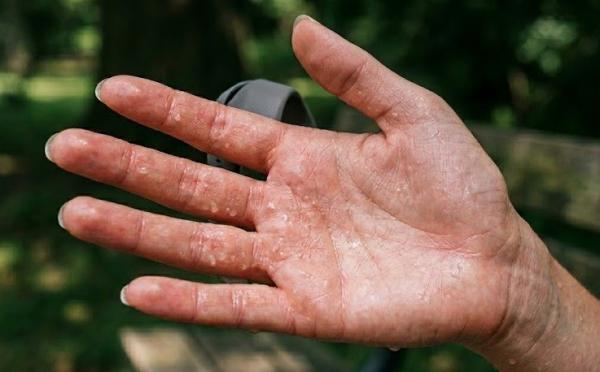 ---
Keringat Berlebih di Telapak Tangan: Tanda Hiperhidrosis yang Perlu Diketahui

---
