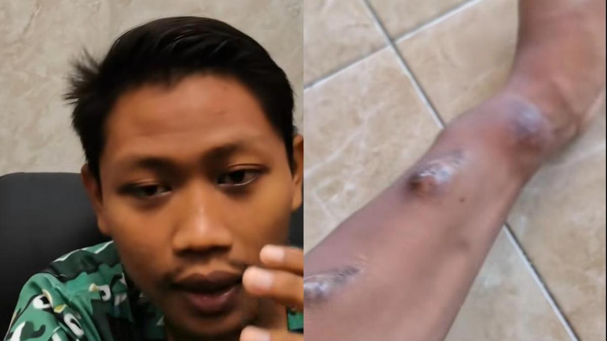 Kisah Edi Utomo: Pria Muda dari Tuban Berjuang Melawan Gagal Ginjal Akibat Konsumsi Mi Instan